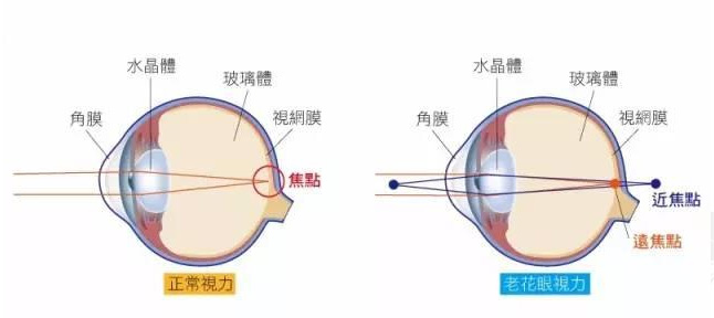 500度近視又老花，戴上美麗島多焦鏡煩惱全解決，46歲的周先生樂壞了